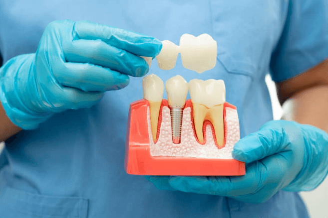 How Dentists Recreate Natural Tooth Anatomy After Significant Damage