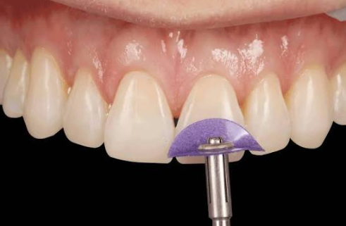 How Composite Edge Bonding Can Restore Length To Worn Front Teeth