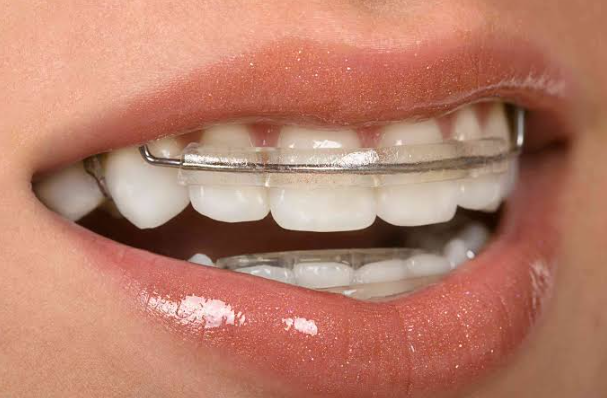 The Importance Of Retainers After Orthodontic Treatment